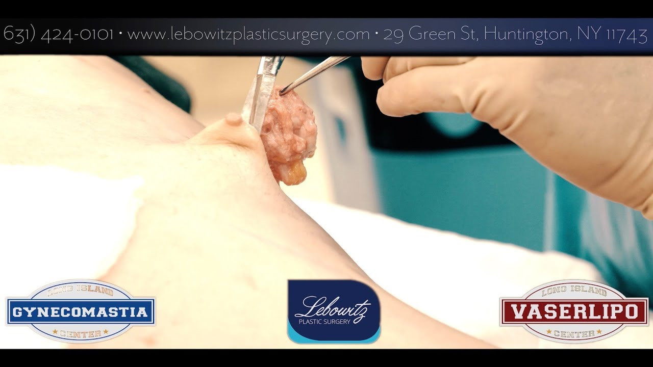 14 Unique Vaser Facelift 2024 free download vaser facelift of hi def vaser lipo gynecomastia chest contour at the gynecomastia regarding hi def vaser lipo gynecomastia chest contour at the gynecomastia center long island huntington ny