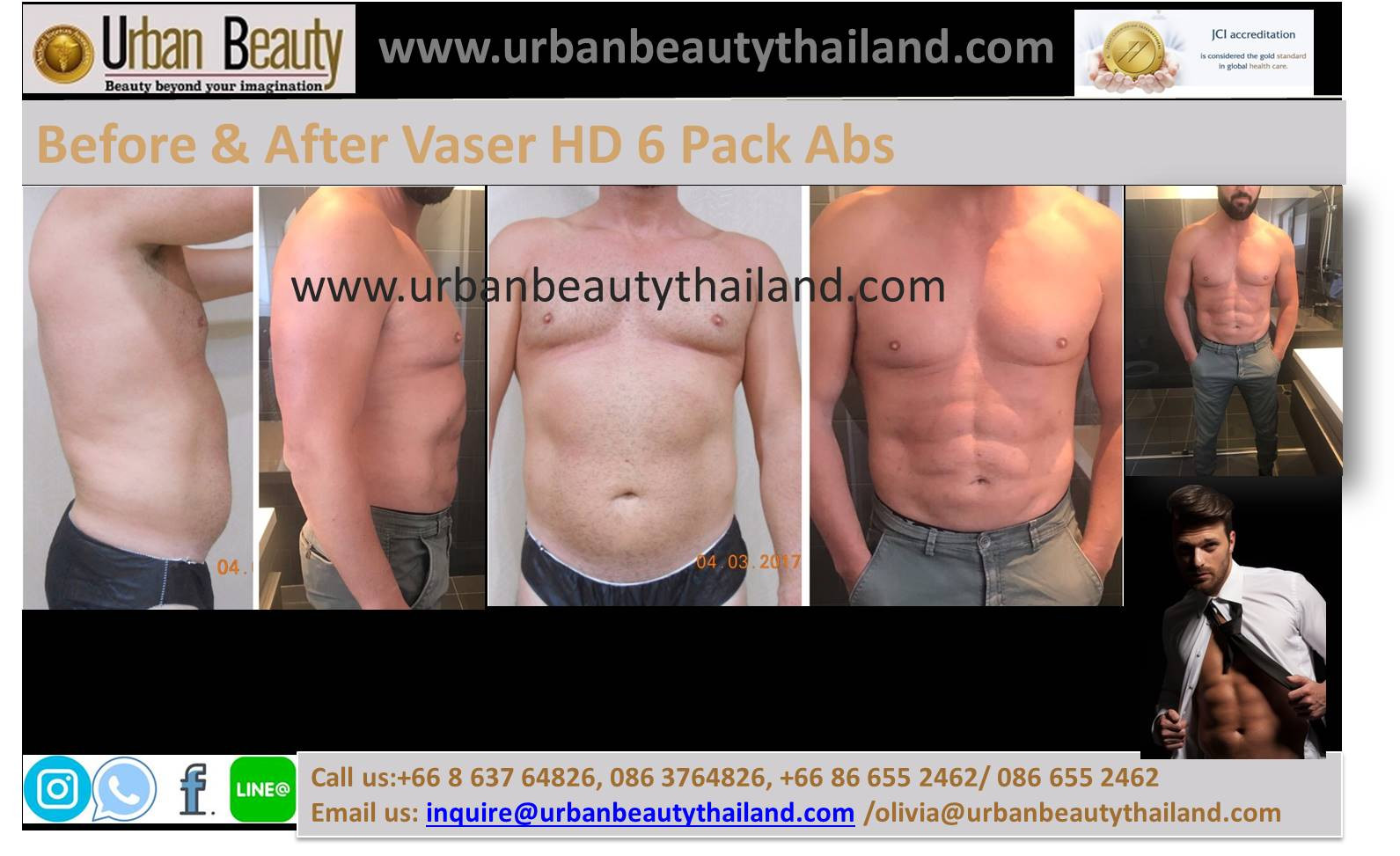 14 Unique Vaser Facelift 2024 free download vaser facelift of low cost vaser ultrasound liposuction vaser hi def ac2b8obangkok phuket in cosmetic surgery in thailand vaser ultrasound liposuction vaser hi def low cost liposuction in ba