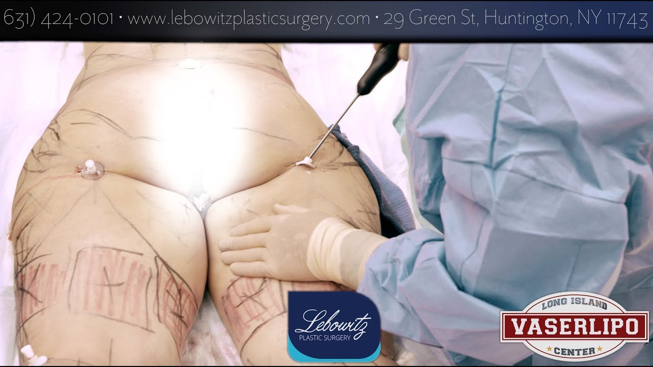 14 Unique Vaser Facelift 2024 free download vaser facelift of vaser hi def lipo buttock flanks thighs knees calves long with regard to vaser hi def lipo buttock flanks thighs knees calves long island ny by dr lebowitz