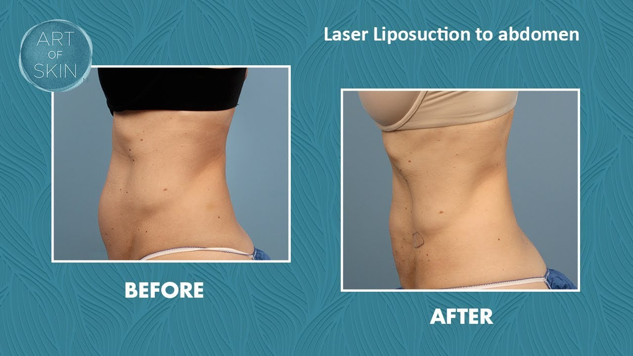 22 Wonderful What is Vaser Liposuction 2024 free download what is vaser liposuction of laser liposuction fat removal and skin tightening on abdomen san pertaining to laser liposuction fat removal and skin tightening on abdomen san diego