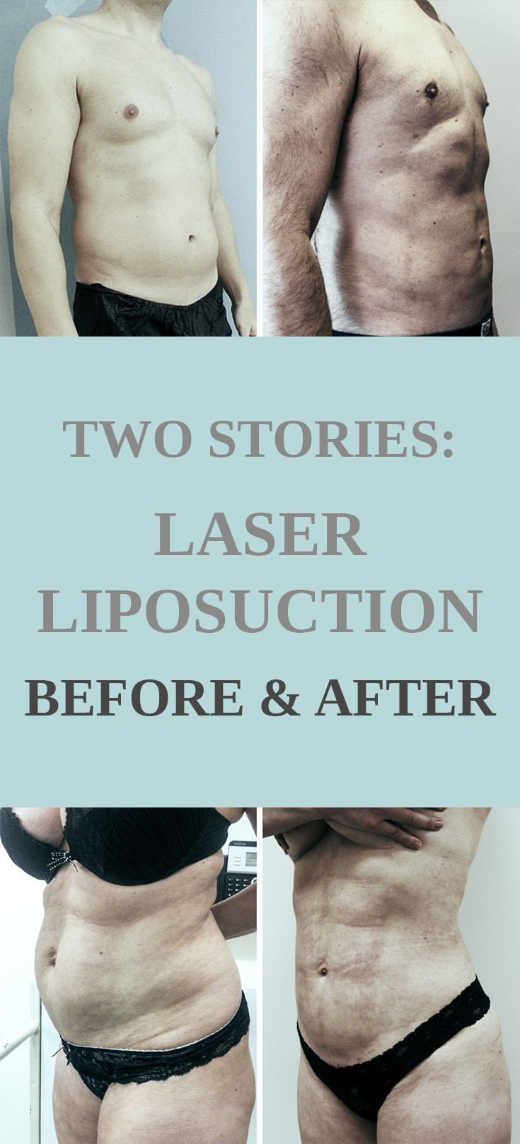 22 Wonderful What is Vaser Liposuction 2024 free download what is vaser liposuction of two stories laser liposuction before and after the sculpture clinic with for further information on what laser liposuction or vaser liposuction can do for you pl