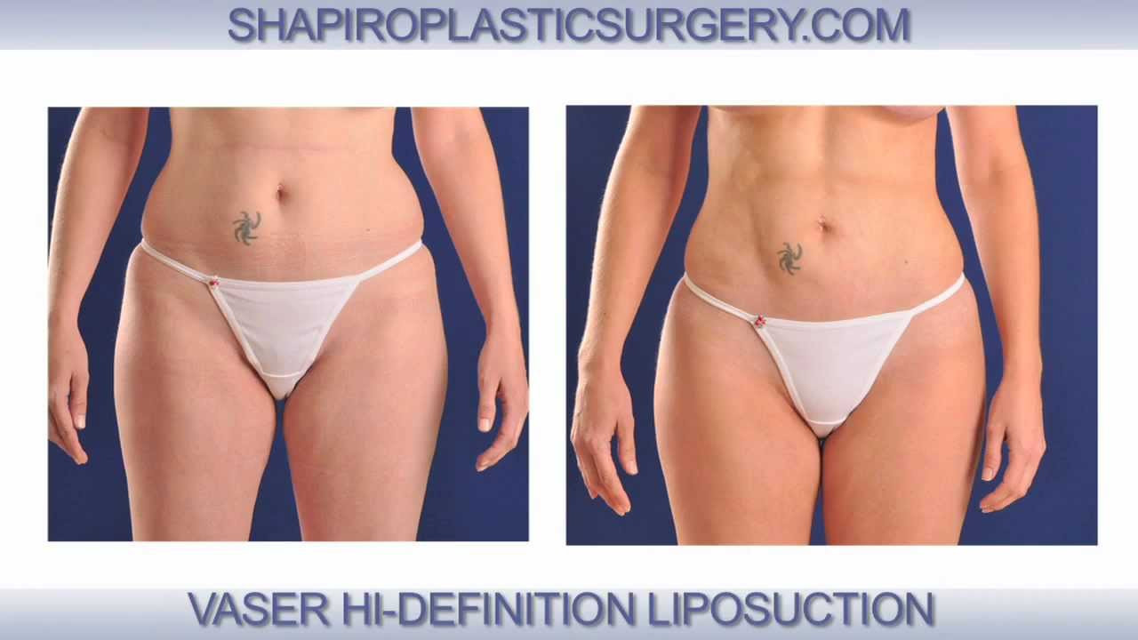 22 Wonderful What is Vaser Liposuction 2024 free download what is vaser liposuction of vaser hi def liposuction procedure by dr shapiro in scottsdale in vaser hi def liposuction procedure by dr shapiro in scottsdale arizona youtube