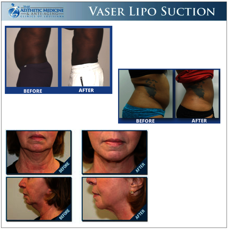 22 Wonderful What is Vaser Liposuction 2024 free download what is vaser liposuction of vaser lipo baton rouge vaser lipo lafayette vaser liposuction regarding what body areas can be treated with vaser lipo