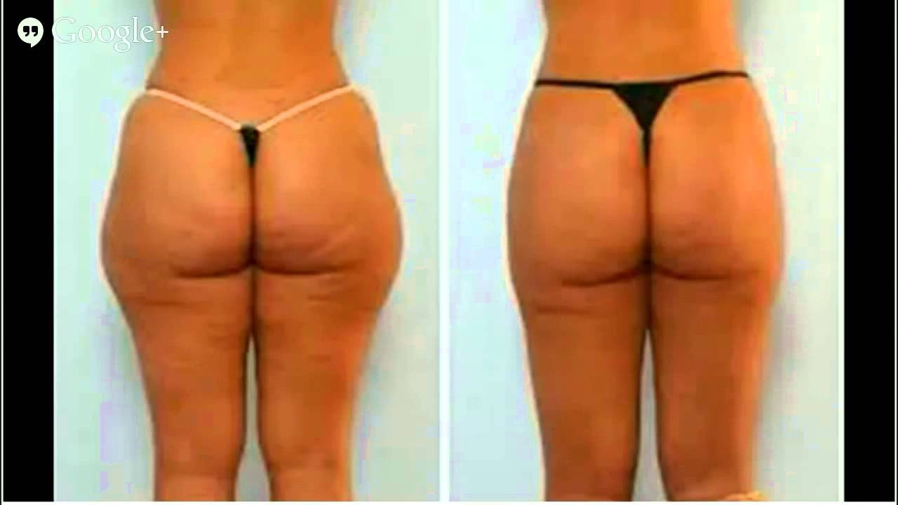 22 Wonderful What is Vaser Liposuction 2024 free download what is vaser liposuction of vaser lipo cost liposuction lipo hd lipo youtube pertaining to maxresdefault